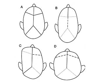 Synostosis:premature suture closure